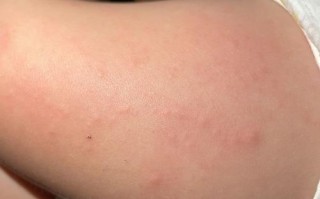 新生儿大腿根部湿疹反复发作怎么办？日常护理要注意这几点吗？