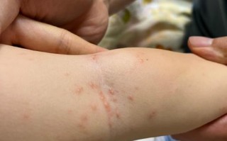 儿童起风疹的症状图片有哪些典型表现及如何辨别？