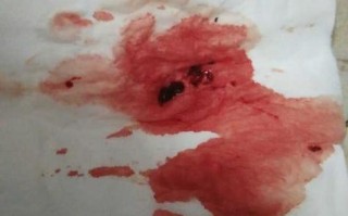 怀孕期间流产是否一定会伴随流血？还有哪些其他症状需要警惕？