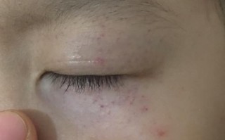 新生儿眼睛周围小红点是正常现象还是疾病信号？需要干预吗？