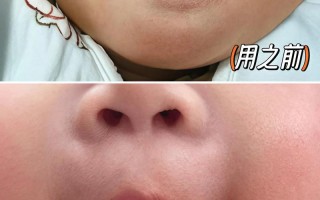 新生儿舌头发黑是正常现象还是疾病信号？需警惕哪些潜在原因？