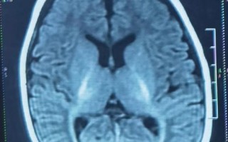 核磁共振检查新生儿脑改变有何临床意义及诊断价值？