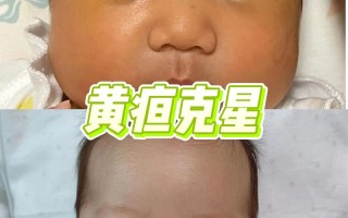 新生儿出生第三天黄疸值偏高需要干预吗？