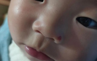 新生儿鼻粘膜损伤图片显示什么症状？如何正确处理和预防？