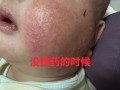 儿童脸上密密麻麻小疙瘩是啥原因？