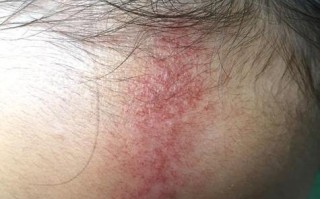 新生儿脸上头上有小红点是湿疹还是痱子？需要治疗吗？