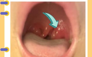 儿童扁桃体肿大到底该怎么治？手术还是保守治疗？家长该如何选择？