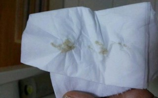 怀孕期间分泌物异常要警惕吗？不同阶段颜色变化代表什么问题？