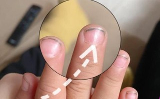 先心病新生儿指甲颜色异常意味着什么？是否与心脏病变程度相关？