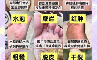 孕期感染脚气了怎么办？用药会不会影响胎儿健康？