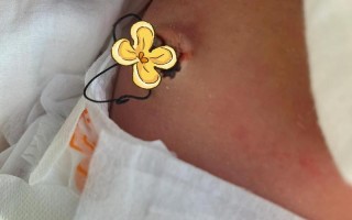 新生儿十天肚脐出血是正常现象还是异常？需要立即就医处理吗？