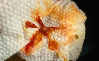 新生儿吐奶带血丝是严重疾病信号还是喂养方式不当？