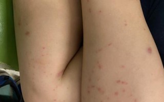 儿童过敏性紫癜能自愈吗？