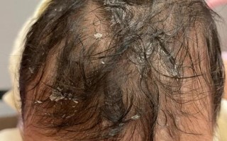 新生儿胎脂多是正常现象还是异常信号？背后原因有哪些？