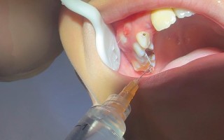 怀孕期间牙痛必须做根管治疗吗？对胎儿有影响吗？