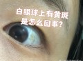 新生儿黄疸白眼球发黄是正常现象还是异常信号？需要干预吗？