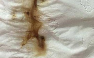 孕期反复出现褐色分泌物，是先兆流产还是其他异常信号？