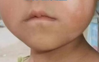 儿童脸上长白斑图片是什么原因？需要警惕哪些疾病？