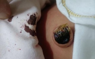 新生儿肚脐出血怎么办？