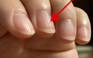 10岁儿童指甲出现竖纹是营养不良还是疾病信号？