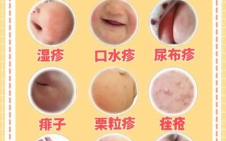 新生儿湿疹晒太阳到底管不管用？晒多久合适？这些家长必知的注意事项！