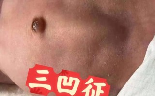 新生儿缺氧的早期症状有哪些容易被家长忽视的危险信号？