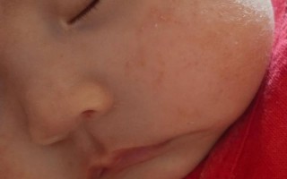 新生儿红色疹子带白头是痱子还是感染？需就医处理吗？