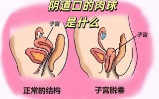 怀孕期间阴壁膨出图片
