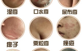 新生儿接种牛痘疫苗的最佳时间是什么时候？需要注意哪些事项？