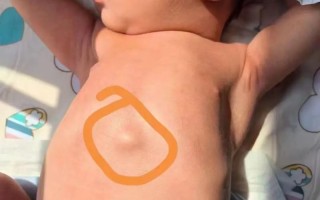 新生儿胸口中间凸起是何原因？