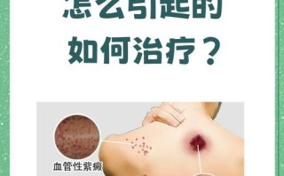 儿童紫癜多久能治好？治疗周期受哪些因素影响？家长该如何科学应对？