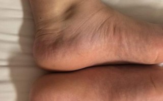 孕期不安腿综合征症状有哪些表现？对胎儿和孕妇健康有影响吗？