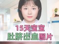 新生儿8天肚脐出血怎么办？