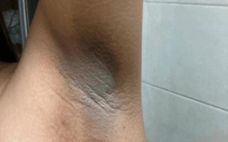 孕期腋窝变黑是激素变化还是色素沉着？该如何科学应对？
