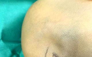 新生儿头部被砸后，家长该如何判断是否需要就医？有哪些异常症状需警惕？