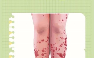 儿童过敏性紫癜会传染给其他小朋友吗？家长需要做好哪些预防措施？