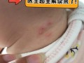 儿童热毒脓疮反复发作怎么办？如何安全有效治疗？