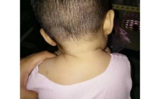 新生儿先天性骨性斜颈，骨骼异常如何影响宝宝颈部发育与未来成长？