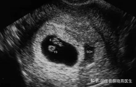 孕期B超检查到底该做几次？-第3张图片-郑州医学网