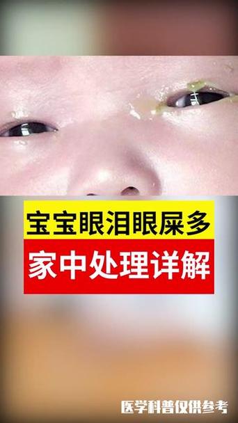 新生儿黄疸眼珠发黄怎么处理？-第3张图片-郑州医学网