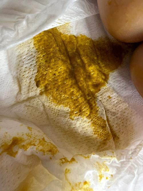 新生儿大便潜血,啥原因?-第2张图片-郑州医学网 新生儿大便潜血,啥原因?-第2张图片-郑州医学网