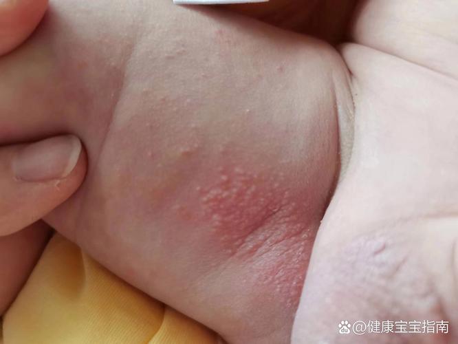 新生儿大腿根部淹了如何处理？-第2张图片-郑州医学网
