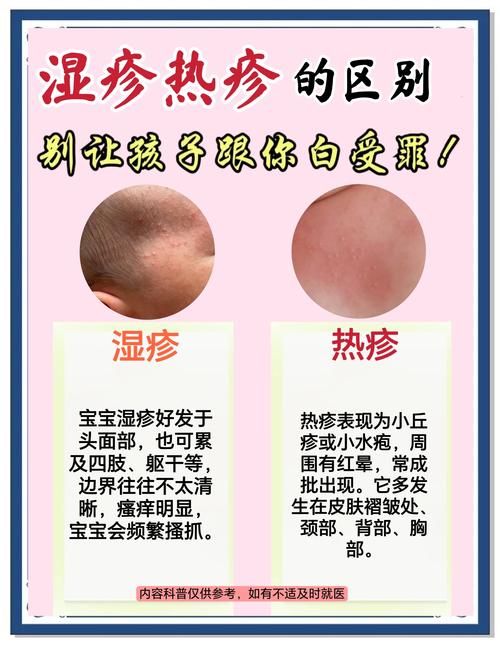 新生儿长湿疹能涂茶油吗？-第2张图片-郑州医学网