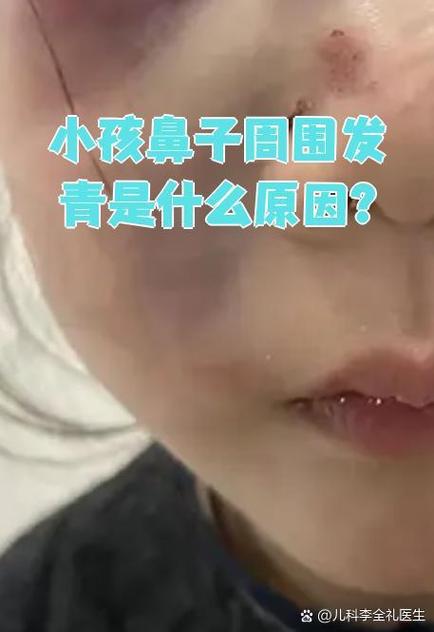 新生儿鼻子嘴巴周围发青是缺氧吗？-第1张图片-郑州医学网