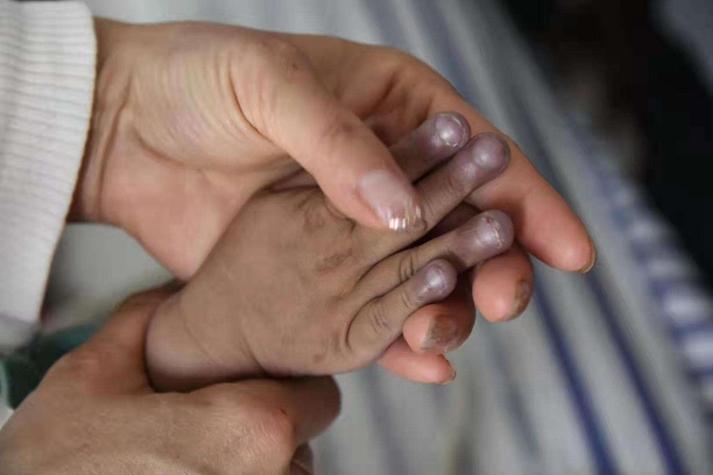 新生儿先心病有哪些典型症状需警惕?-第3张图片-郑州医学网 新生儿先心病有哪些典型症状需警惕?-第3张图片-郑州医学网