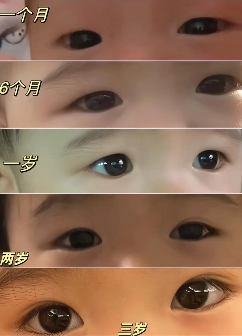 新生儿双眼皮能确定吗?-第1张图片-郑州医学网 新生儿双眼皮能确定吗?-第1张图片-郑州医学网