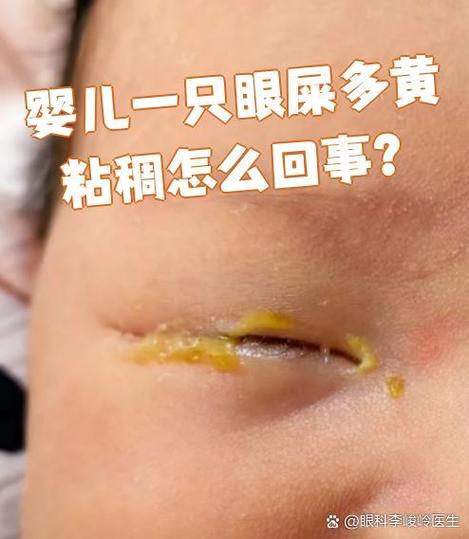 新生儿黄眼屎是上火还是生病了?-第1张图片-郑州医学网 新生儿黄眼屎是上火还是生病了?-第1张图片-郑州医学网