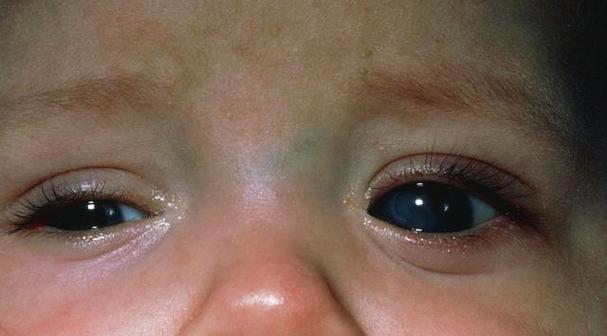 新生儿睡觉翻白眼是何原因?-第2张图片-郑州医学网 新生儿睡觉翻白眼是何原因?-第2张图片-郑州医学网