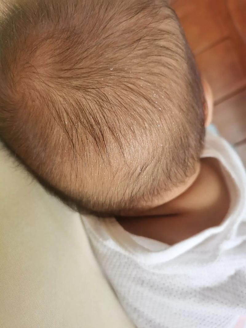 新生儿后脑勺出汗是缺钙还是正常现象？-第2张图片-郑州医学网