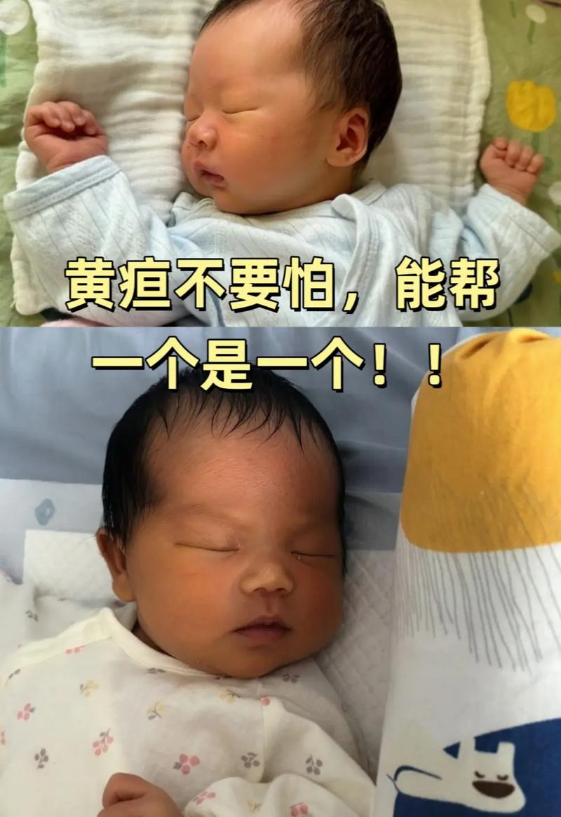 新生儿面部发黄是何原因？-第2张图片-郑州医学网
